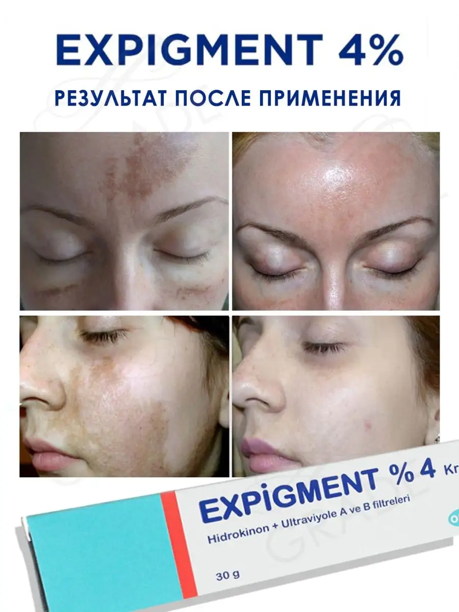 Крем отбеливающий Экспигмент 4% от пигментации Expigment 4% ORVA 44928261  купить в интернет-магазине Wildberries