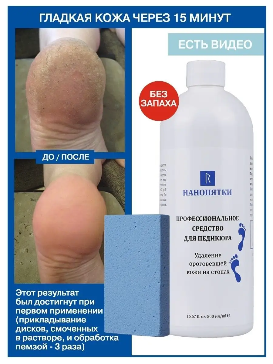 Кератолитик от натоптышей...