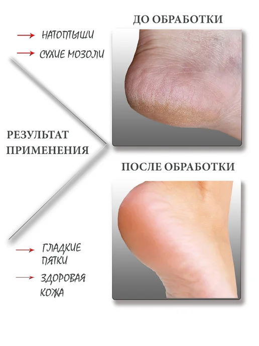 LEOVI Пемза для пяток ног терка с отшелушивающим эффектом, белый, фото 5